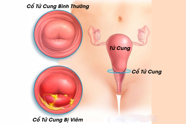 Vệ sinh vùng kín không đúng cách