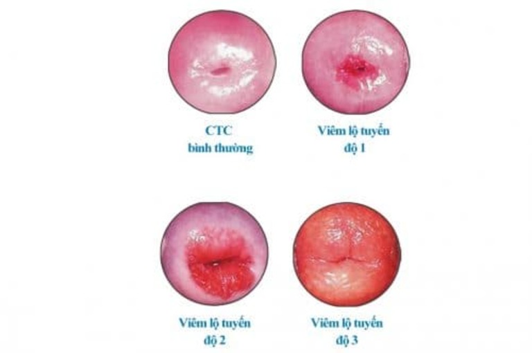 viêm lộ tuyến độ 2 đặt thuốc có khỏi không