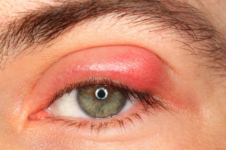 Các biến chứng viêm xoang ở mắt nguy hiểm