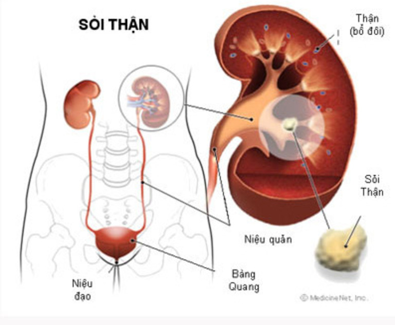 bệnh sỏi thận theo đông y