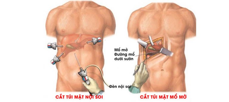 các phương pháp mổ sỏi mật