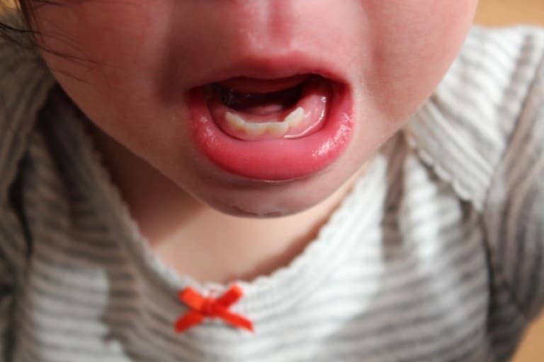 Trẻ bị sưng nướu răng 