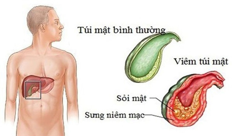 bệnh túi mật thường gặp