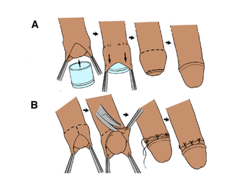 Phương pháp cắt bao quy đầu