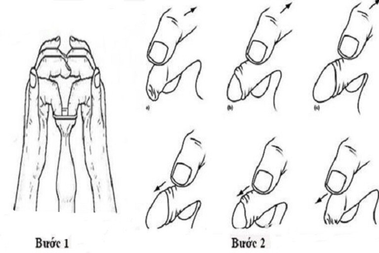 Hướng dẫn phương pháp nong bao quy đầu cho trẻ