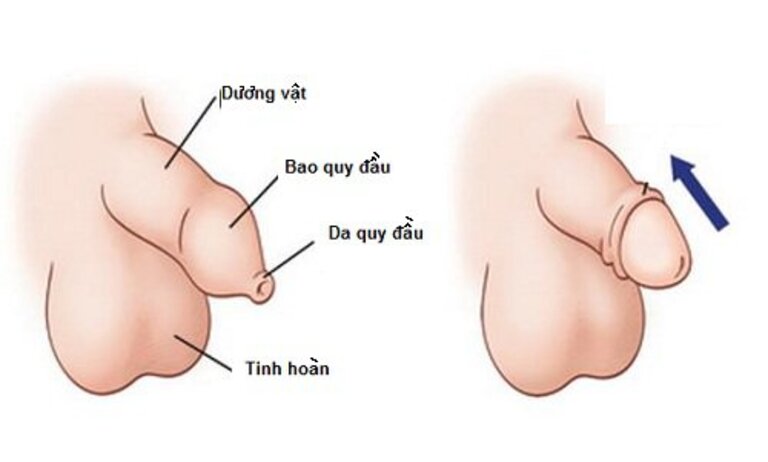 Điều trị đỏ bao quy đầu cho trẻ bằng cách nào?