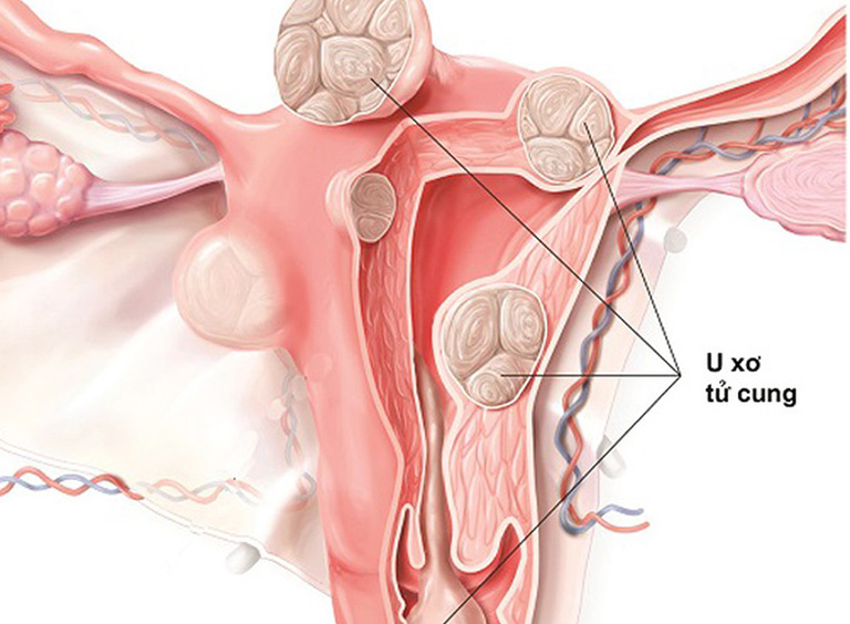 ăn gì để nhân xơ tử cung không phát triển