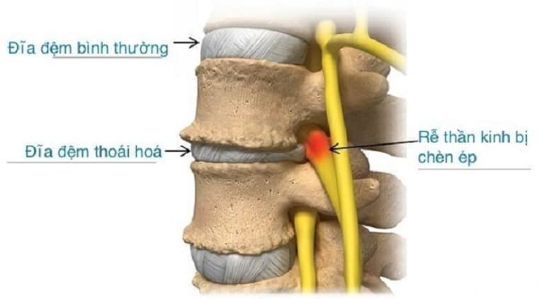 Các biến chứng sau mổ cột sống thường gặp và điều cần biết