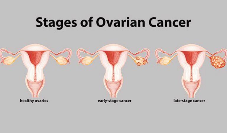 các giai đoạn ung thư buồng trứng