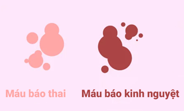 dấu hiệu mang thai khi đặt vòng