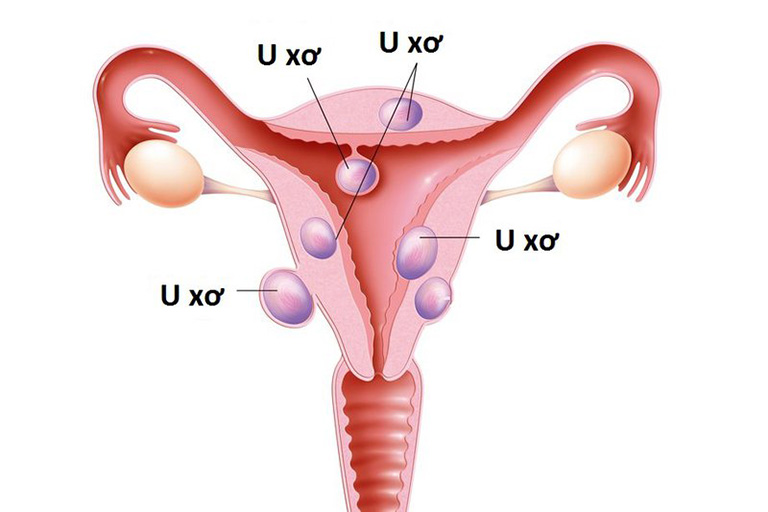 dấu hiệu u xơ tử cung lành tính