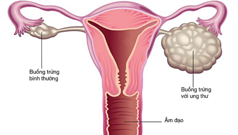 Bệnh ung thư buồng trứng ở trẻ em