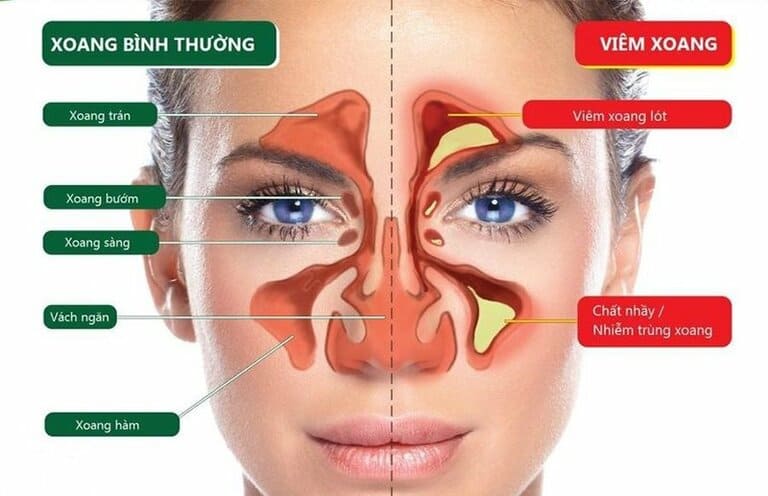 Bệnh viêm xoang hàm là gì?