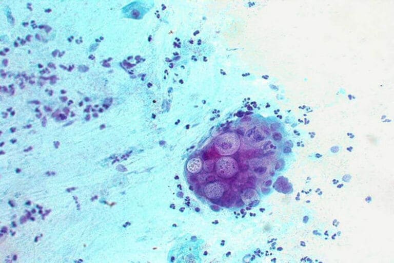 Chlamydia có phải lậu không? Cách nhận biết, phân biệt