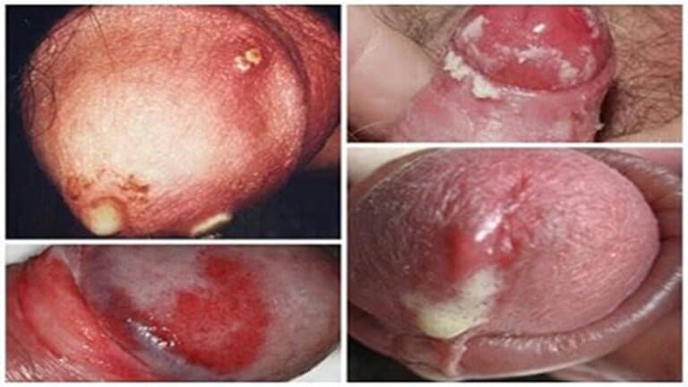 bệnh Chlamydia có phải lậu không