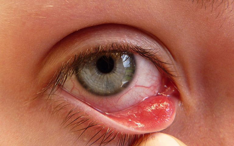 dấu hiệu nhận biết Chlamydia ở mắt