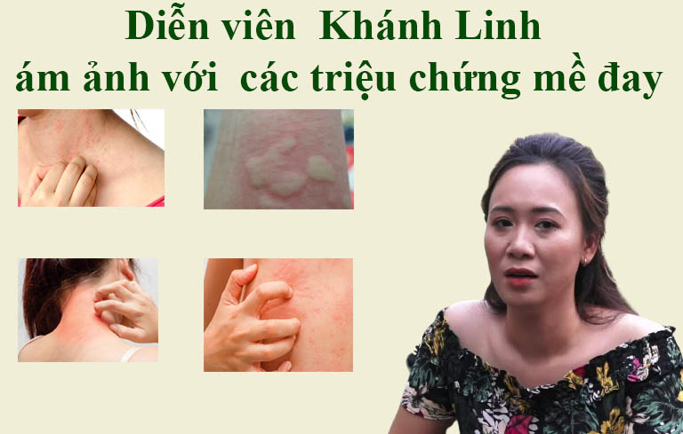 Diễn viên Khánh Linh luôn bị ám ảnh với triệu chứng bệnh mề đay