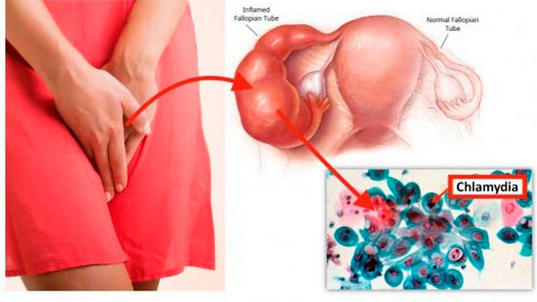 Nhiễm Chlamydia Trachomatis sinh dục