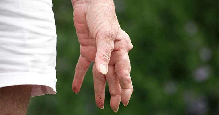Nổi cục ở đốt ngón tay là bệnh gout