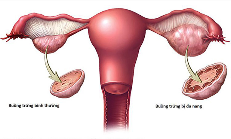 mang thai nhưng không có dấu hiệu