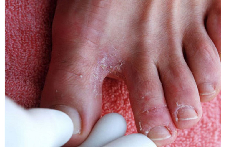 Bệnh nấm ăn chân là bị gì?