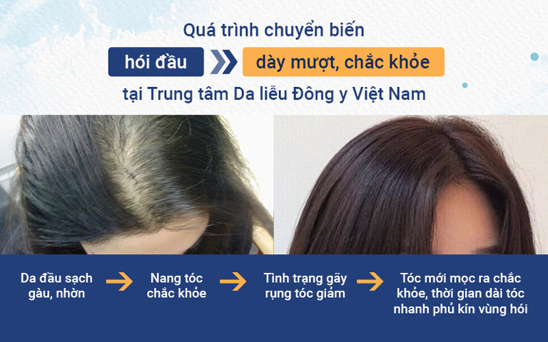 Những chuyển biến tích cực của khách hàng sau khi điều trị rụng tóc tại Trung tâm Da liễu Đông y Việt Nam 