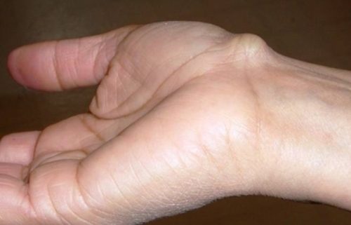 Nổi cục ở mu bàn tay là bị gì? Có nguy hiểm không?