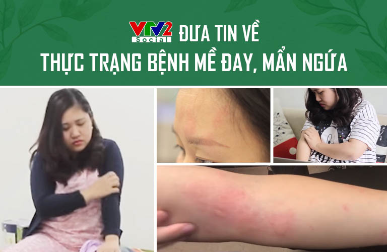 Các triệu chứng nổi mề đay mẩn ngứa