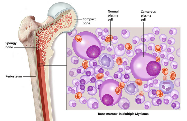 hình ảnh bệnh đa u tủy xương