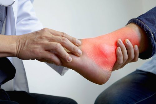 phác đồ điều trị gout