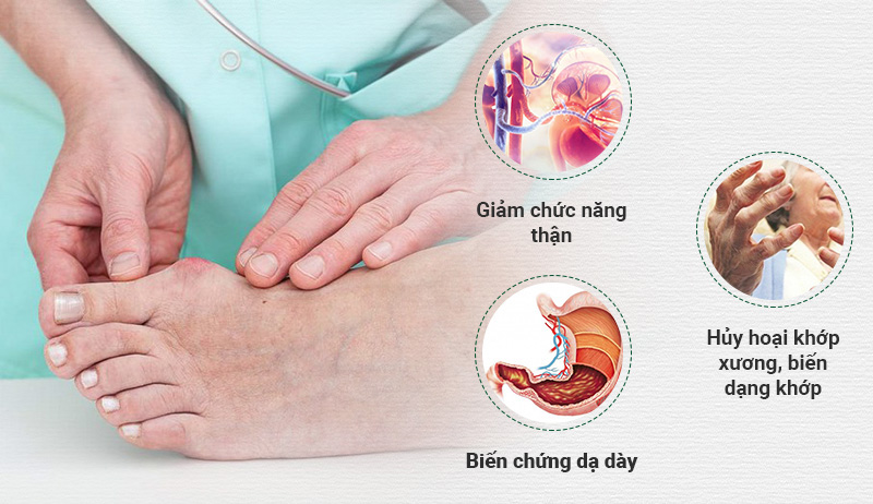 Bệnh Gút để lại những biến chứng vô cùng nguy hiểm