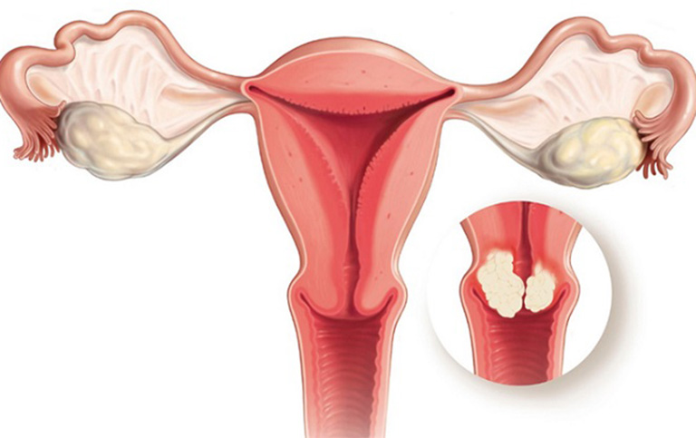loạn sản cổ tử cung