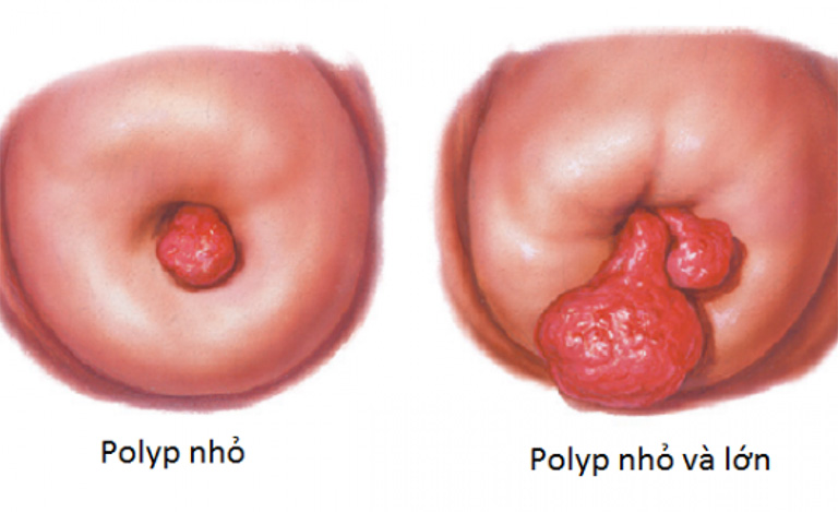 cổ tử cung bị tổn thương