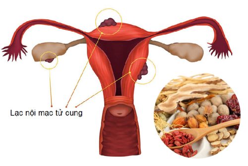 chữa lạc nội mạc tử cung bằng đông y