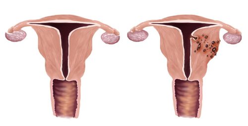 Lạc nội mạc trong cơ tử cung