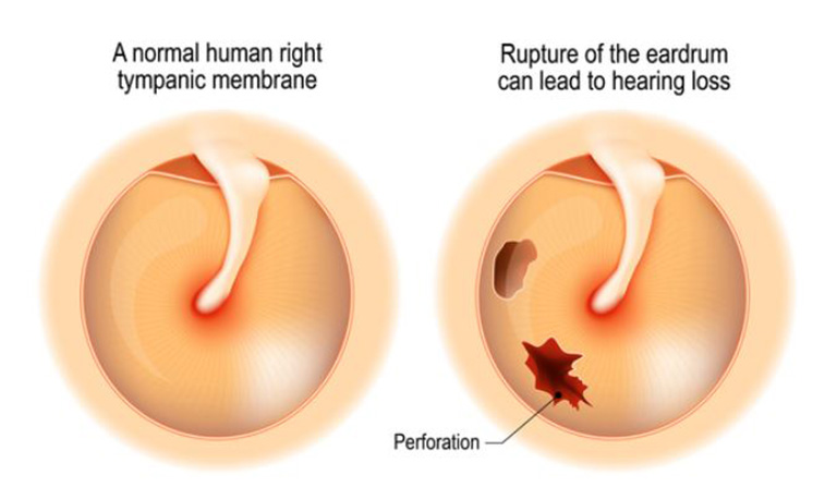 Viêm tai giữa mạn tính có cholesteatoma là bệnh gì?
