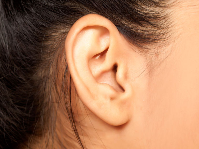 Viêm tai giữa mạn tính có cholesteatoma