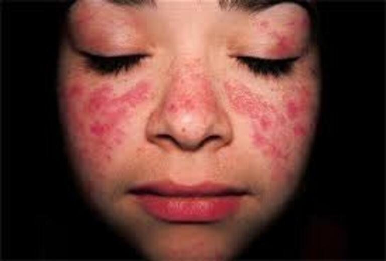 Dấu hiệu của bệnh viêm thận Lupus