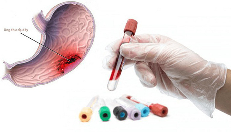 Xét nghiệm máu dùng để xét nghiệm ung thư dạ dày 