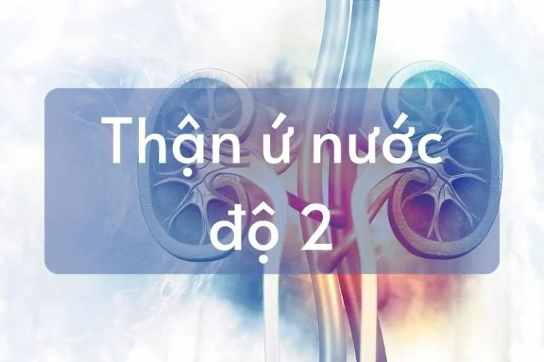 Thận ứ nước độ 2