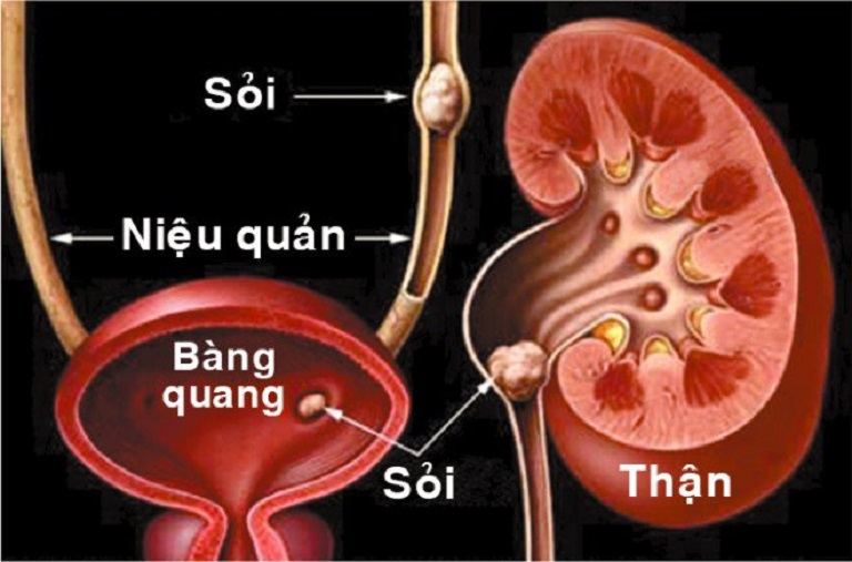 nguyên nhân gây thận ứ nước độ 4