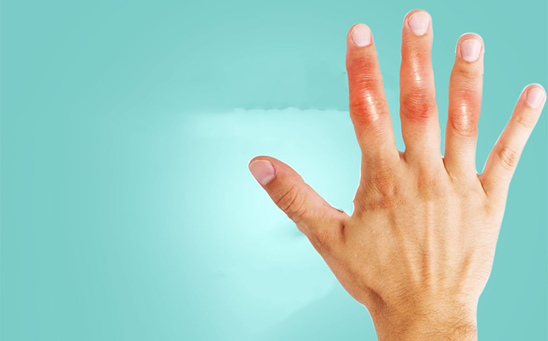 Bệnh viêm khớp ngón tay là gì?