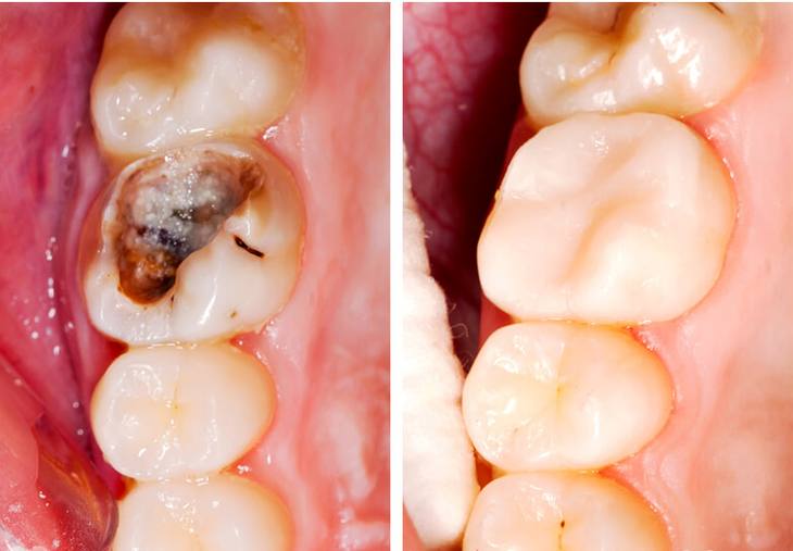 Trám răng sâu được thực hiện trong một số trường hợp