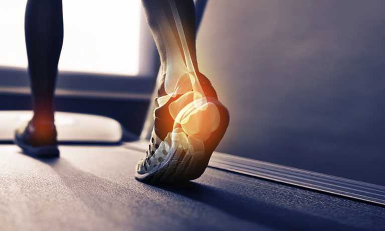 có nên đi bộ khi bị bệnh gai gót chân hay không?