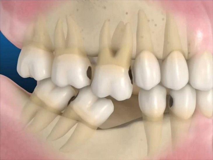 Người bệnh có thể sẽ mất răng nếu không điều trị bệnh kịp thời