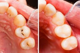 Sâu răng nhẹ: Dấu hiệu nhận biết và cách điều trị dứt điểm