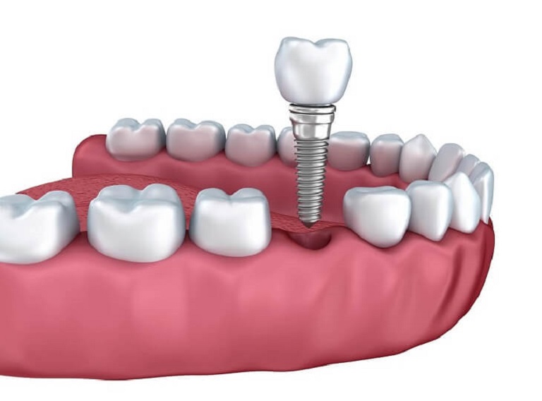 Nên chọn phương pháp trồng răng Implant khi phải nhổ bỏ răng bị sâu