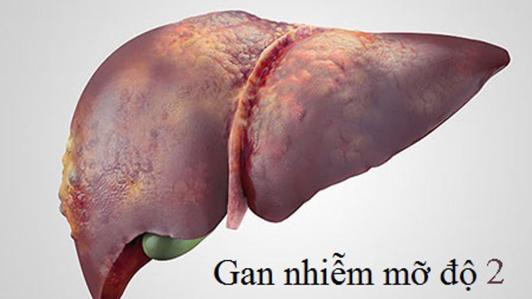 Gan nhiễm mỡ độ 2