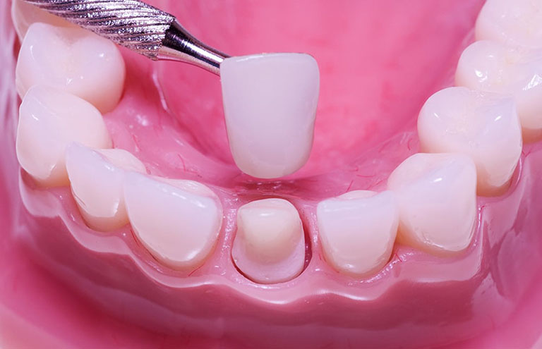 Phương pháp bọc răng sứ thường dùng cho trường hợp răng sứt mẻ, răng sâu