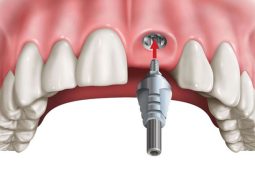 Trồng răng cửa có đau không và những lưu ý quan trọng